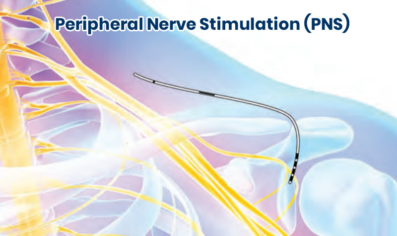 Interventional Pain Management, Pain Management Solutions, Chronic Pain Treatment, Nerve Pain Management, Spinal Cord Stimulator, Non-Surgical Pain Relief, Medial Branch Nerve Blocks, Joint Injections For Arthritis, Herniated Disc Treatment, Pain Relief For Muscle Strain, Pain Alleviation