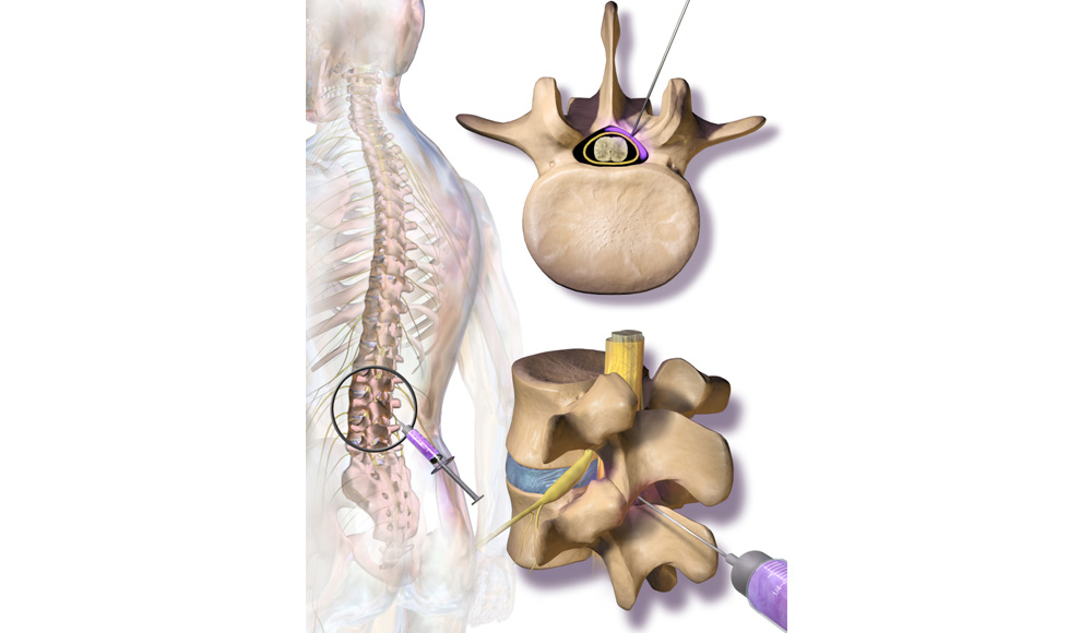 Interventional Pain Management, Pain Management Solutions, Chronic Pain Treatment, Nerve Pain Management, Spinal Cord Stimulator, Non-Surgical Pain Relief, Medial Branch Nerve Blocks, Joint Injections For Arthritis, Herniated Disc Treatment, Pain Relief For Muscle Strain, Pain Alleviation