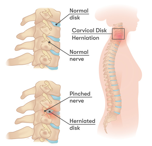 Interventional Pain Management, Pain Management Solutions, Chronic Pain Treatment, Nerve Pain Management, Spinal Cord Stimulator, Non-Surgical Pain Relief, Medial Branch Nerve Blocks, Joint Injections For Arthritis, Herniated Disc Treatment, Pain Relief For Muscle Strain, Pain Alleviation