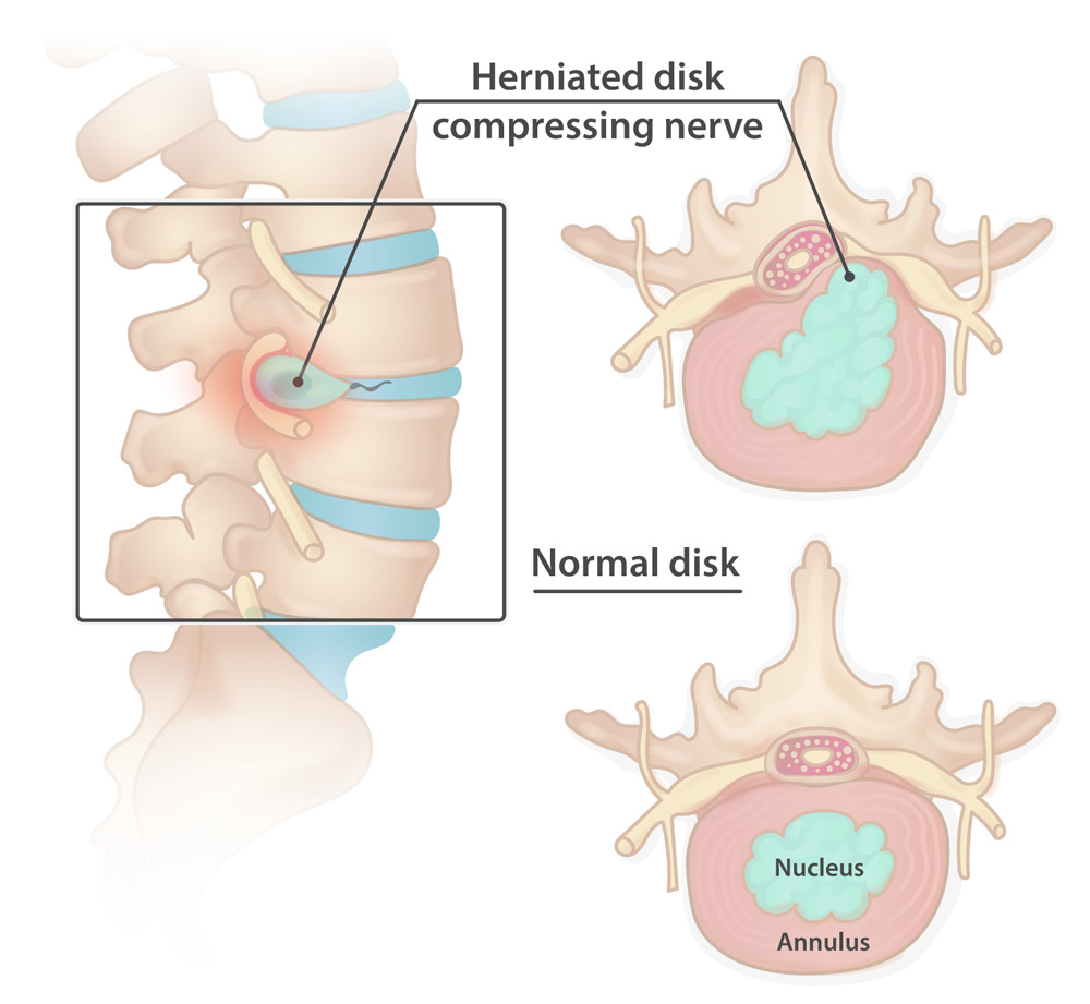 Interventional Pain Management, Pain Management Solutions, Chronic Pain Treatment, Nerve Pain Management, Spinal Cord Stimulator, Non-Surgical Pain Relief, Medial Branch Nerve Blocks, Joint Injections For Arthritis, Herniated Disc Treatment, Pain Relief For Muscle Strain, Pain Alleviation