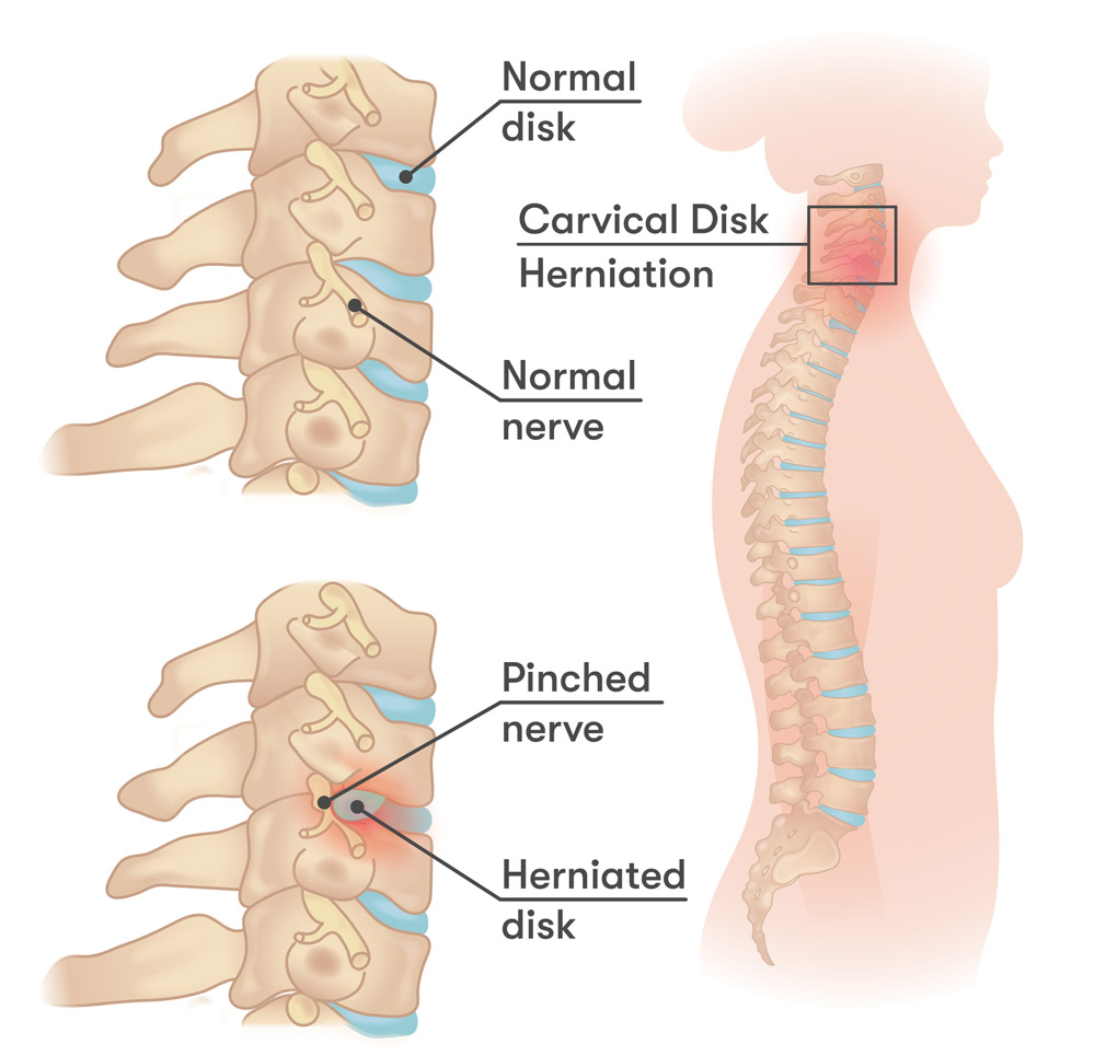 Interventional Pain Management, Pain Management Solutions, Chronic Pain Treatment, Nerve Pain Management, Spinal Cord Stimulator, Non-Surgical Pain Relief, Medial Branch Nerve Blocks, Joint Injections For Arthritis, Herniated Disc Treatment, Pain Relief For Muscle Strain, Pain Alleviation