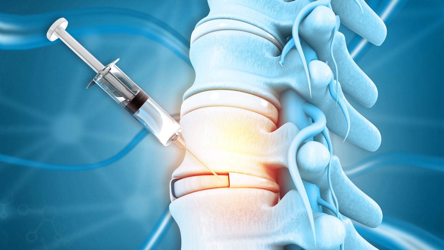 Epidural Steroid Injections for Nerve Pain Relief in the Five Towns, NY Area