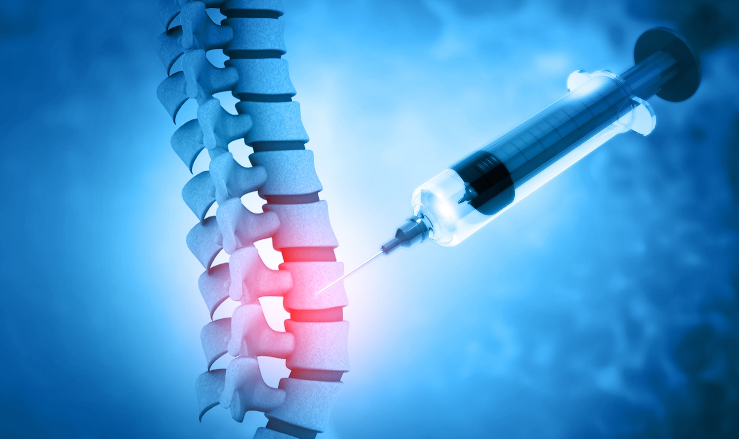 Epidural Steroid Injections For Pain Relief