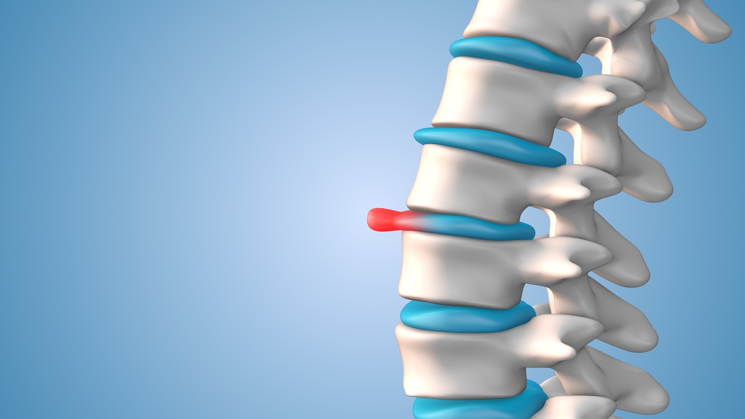 Herniated Disc Treatment in Woodmere