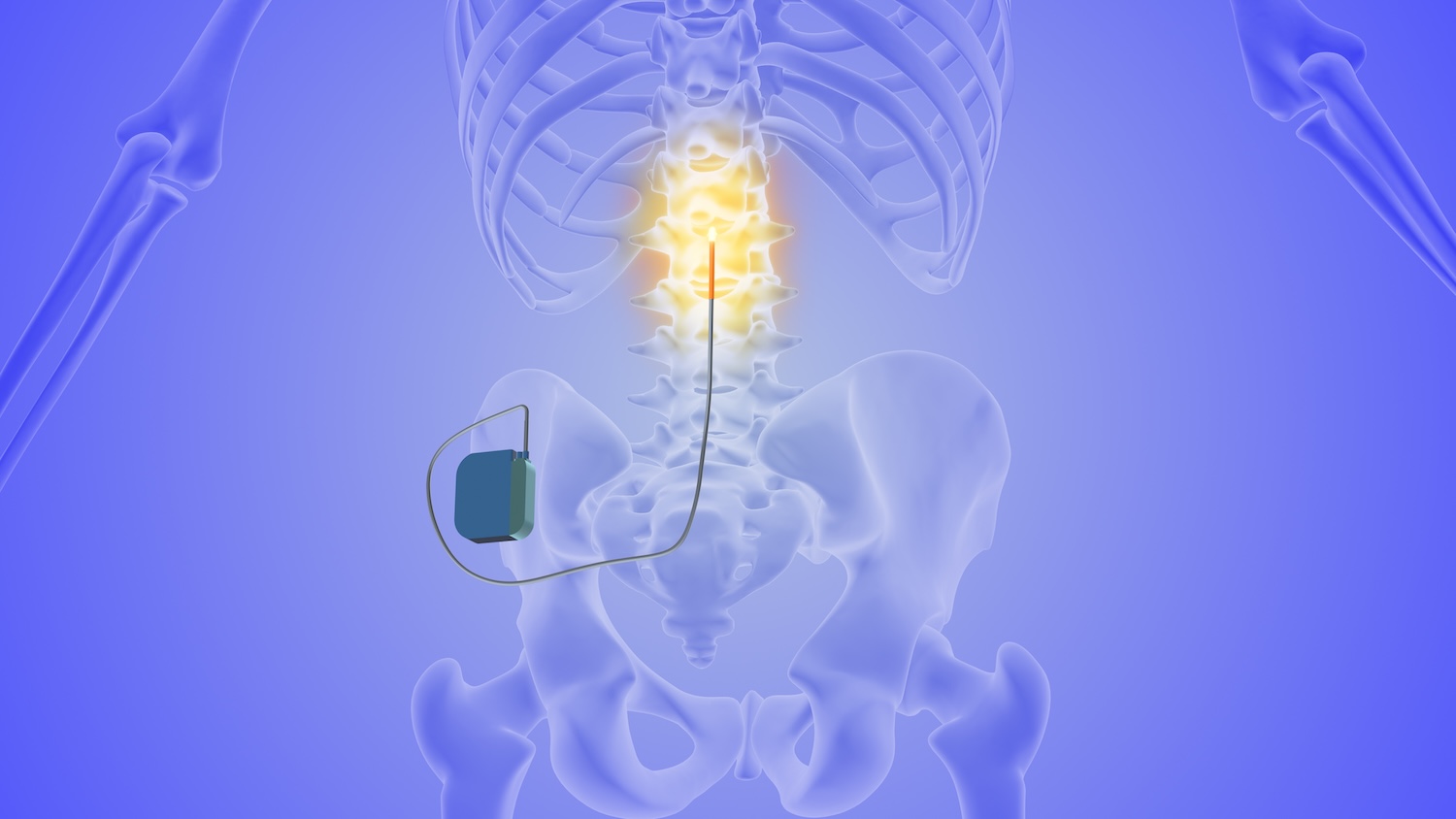 Spinal Cord Stimulation
